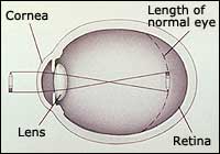 Myopia