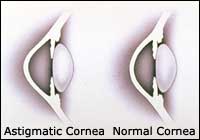 A-23_Astigmatism_Lo