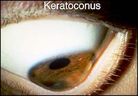 Keratoconus