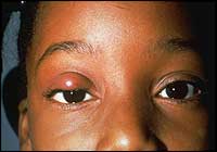 Chalazion