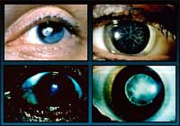 Cataract Types