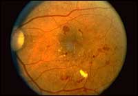 diabetic retinopathy