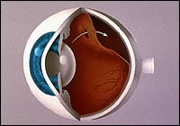 Retinal Detachment