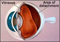 Vitreous Detachment