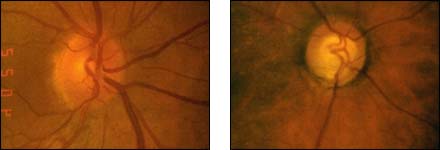 Normal and Cupped Disc