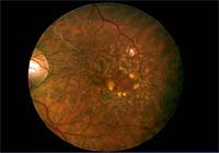 Macular Degeneration