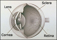 keratoconus